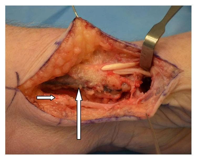 This clinical photograph displays a surgical dissection of the volar and radial aspects of a human left wrist during a trapeziectomy and ligament reconstruction procedure. The surgical site reveals the underlying anatomy with several key structures annotated. A vertical arrow points to the radial artery, which appears as a distinct, dark vascular cord. Notably, the flexor carpi radialis (FCR) tendon is congenitally absent in the expected location ulnar to the radial artery, showing only soft tissue and fat instead of a discrete tendon. A horizontal arrow indicates the palmaris longus tendon, visible as a superficial, striated, cord-like structure located inferiorly. Superiorly, the abductor pollicis longus (APL) and extensor pollicis brevis (EPB) tendons are identified near the thumb base, retracted to expose the deeper surgical field. This image serves as an educational example of anatomical variation in hand surgery, specifically the rare absence of the FCR tendon and its impact on surgical planning for carpometacarpal (CMC) joint osteoarthritis.