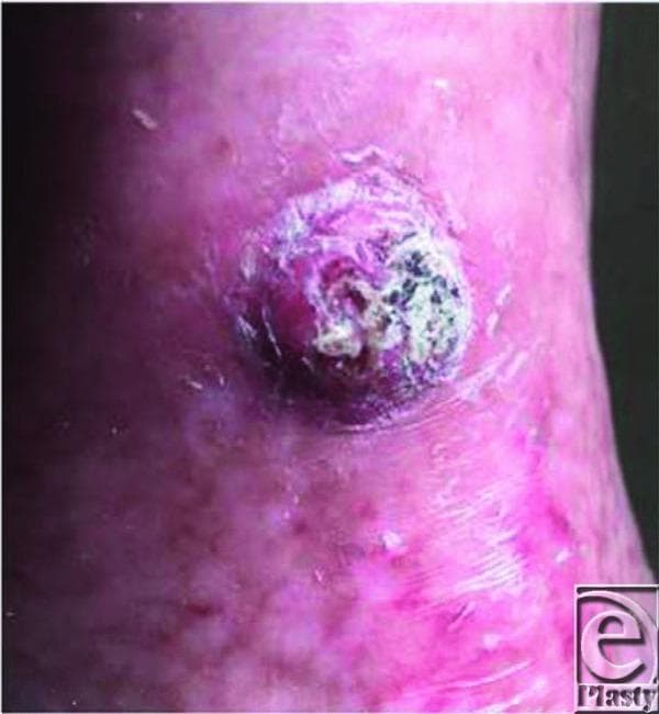 This clinical photograph displays a close-up view of a prominent exophytic lesion on the left tibial region. The lesion is approximately circular but possesses irregular, raised borders and a friable, non-uniform surface characterized by granulation tissue, focal ulceration, and crusting. The color is variegated, showing a mixture of erythematous (red/pink), dusky purple, and dark grey/black tones. The surrounding skin exhibits clear signs of chronic tissue change consistent with a previous burn injury and subsequent autografting, including altered pigmentation, shiny texture, and scarring. A localized zone of erythema and induration is visible immediately adjacent to the base of the mass. Clinically, this presentation is highly suggestive of a Marjolin's ulcer—a squamous cell carcinoma (SCC) arising within a chronic wound or scar. This image illustrates key morphological red flags for malignancy in chronic wounds, such as rapid growth, exophytic architecture, and heterogeneous coloration in an area of prior thermal trauma.