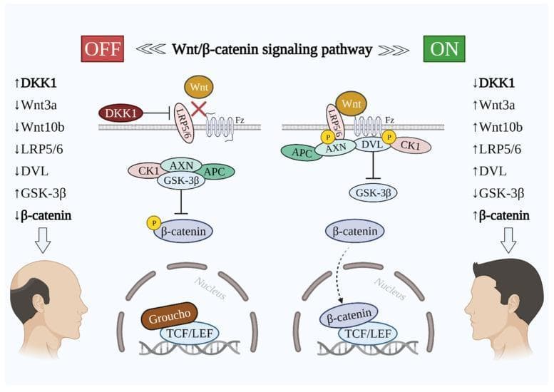 A comparative medical illustration detailing the Wnt/β-catenin signaling pathway in the context of hair growth and loss (androgenetic alopecia). The diagram is split into two states: 'OFF' (left) and 'ON' (right).
In the 'OFF' state, DKK1 is upregulated, binding to and inhibiting the LRP5/6 co-receptor. This prevents Wnt ligands (Wnt3a, Wnt10b) from activating the Frizzled (Fz) receptor. Consequently, a cytoplasmic destruction complex (composed of CK1, AXN, GSK-3β, and APC) phosphorylates β-catenin, leading to its degradation. Within the nucleus, the repressor Groucho remains bound to TCF/LEF, suppressing gene transcription. This state is visually correlated with a male profile showing significant hair thinning and a receding hairline.
In the 'ON' state, DKK1 is downregulated, allowing Wnt ligands to bind the Fz-LRP5/6 complex. This recruits Dishevelled (DVL), inactivating the destruction complex and inhibiting GSK-3β. Stabilized β-catenin translocates into the nucleus, displaces Groucho, and binds TCF/LEF to initiate hair growth-related gene expression. This state is correlated with a male profile showing full hair density.