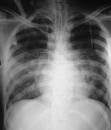Anteroposterior (AP) chest radiograph demonstrating severe, bilateral, diffuse pulmonary edema. The image shows extensive, fluffy, alveolar opacities with a predominant perihilar (bat-wing) distribution, extending towards the peripheral lung fields and obscuring normal vascular markings. Cardiomegaly is evident, with an increased cardiothoracic ratio. Multiple medical support devices are visible: an endotracheal tube is positioned within the trachea, a central venous catheter is noted via the right jugular approach, and external monitoring electrodes are present on the chest wall. The costophrenic angles appear blunted, consistent with associated pleural effusions. In the context of the clinical history, these findings represent acute cardiogenic or non-cardiogenic pulmonary edema following tricyclic antidepressant (TCA) toxicity and subsequent cardiac arrest. The skeletal structures, including the ribs and clavicles, appear intact. This diagnostic image serves as an educational example of severe pulmonary congestion and the visual manifestations of heart failure or acute respiratory distress in a critical care setting.