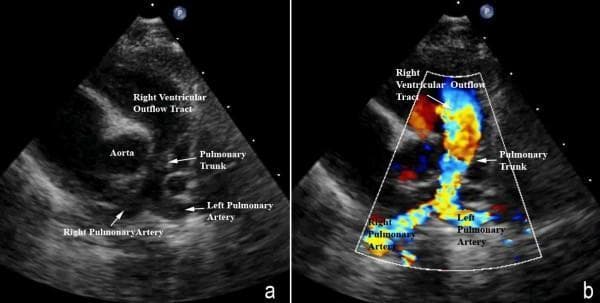 Two-panel diagnostic ultrasound image demonstrating Tetralogy of Fallot anatomy and hemodynamics. Panel (a) is a 2D grayscale echocardiogram in a modified parasternal short-axis view showing the right ventricular outflow tract (RVOT), the aorta, and the pulmonary arteries. There is significant hypoplasia of the pulmonary trunk and the right and left pulmonary arteries, resulting from the antero-cephalad deviation of the outlet septum. The pulmonary valve leaflets are not clearly visualized. Panel (b) utilizes color Doppler imaging to map blood flow through the same structures. It reveals marked turbulence and flow acceleration, represented by a mosaic of red, yellow, and blue colors, beginning at the level of the deviated outlet septum in the RVOT. This high-velocity turbulent flow continues through the stenotic, hypoplastic pulmonary trunk into the pulmonary artery branches. This clinical imaging is essential for assessing the severity of subpulmonary obstruction and hypoplasia in congenital heart disease management.