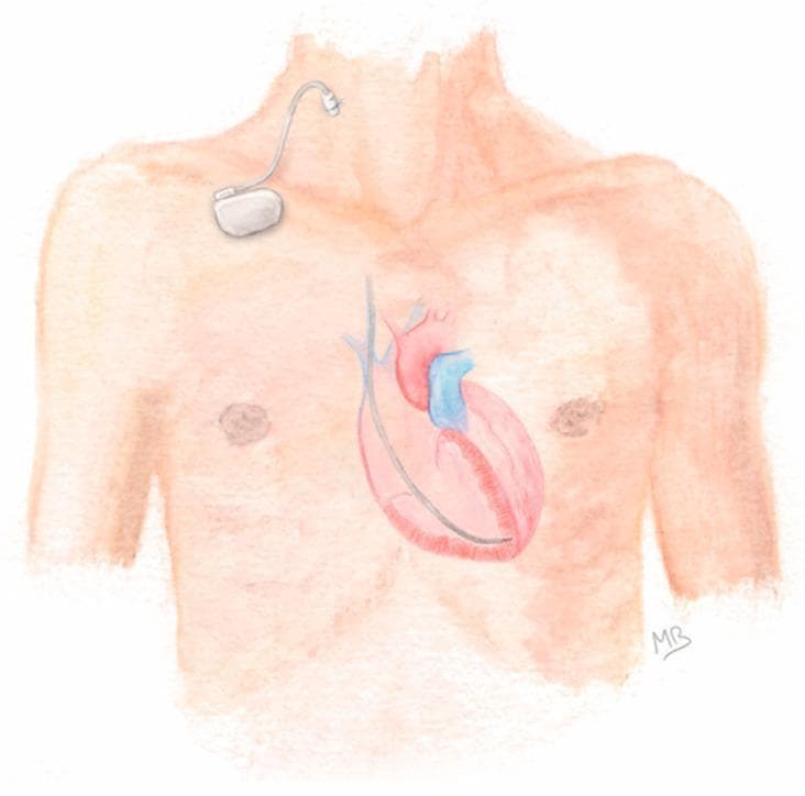 Anatomical diagram illustrating the configuration for Prolonged Temporary Cardiac Pacing (PTCP). The illustration shows a human torso with a focus on the cardiovascular and pacing systems. A silver-colored, single-chamber pacemaker generator is positioned externally on the patient's upper right chest, secured to the skin. An active-fixation lead is connected to the generator and enters the venous system via a percutaneous puncture of the right internal jugular vein. The lead is shown descending through the superior vena cava, entering the heart, and terminating with its tip anchored in the apex of the right ventricle. The diagram highlights the clinical pathway for temporary pacing in patients with transient conduction disorders or those with contraindications to permanent implantation, such as active infection. Key components depicted include the external pulse generator, the transvenous lead, the jugular venous access site, and the intracardiac positioning within the right ventricular cavity.