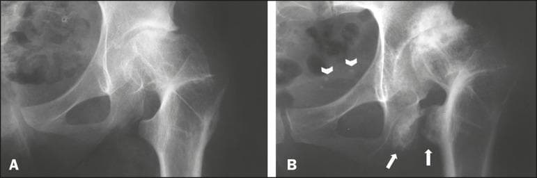 Diagnostic Image: This side-by-side comparison includes two anteroposterior (AP) radiographs of the left hip (A and B) demonstrating long-term progression of orthopedic pathology following a valgus intertrochanteric osteotomy. Panel A, taken one year post-surgery, shows early signs of osteoarthritis with relatively preserved hip joint space and a baseline ischiofemoral distance between the lesser trochanter and the ischium. Panel B, obtained 30 years post-operatively, shows significant advancement of hip osteoarthritis characterized by joint space narrowing and subchondral sclerosis. Notably, Panel B exhibits hallmarks of ischiofemoral impingement, highlighted by white arrows indicating a marked narrowing of the ischiofemoral space. Distinctive visual features include cortical irregularity, reactive bone remodeling, and osteosclerosis on the opposing surfaces of the lesser trochanter and the ischial tuberosity. The image serves as a clinical reference for secondary hip osteoarthritis and the mechanical consequences of altered proximal femoral anatomy leading to extra-articular impingement.