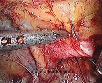 This endoscopic clinical photograph depicts an intraoperative view of the preperitoneal space during a Totally Extraperitoneal (TEP) inguinal hernia repair. The focal point is the conjoined tendon arch (indicated by a black arrow and text label), which appears as a reddish-pink, fibrous anatomical structure. A metallic laparoscopic instrument is visible, positioned to perform a puncture and suturing through the tendon arch using a suture needle. The surrounding surgical field shows thin, translucent connective tissues, small blood vessels, and adjacent musculature of the posterior abdominal wall. This image serves as an educational guide for identifying key landmarks in the inguinal region and demonstrates a specific technique for internal ring suturing to reduce the defect size before mesh placement. The educational focus is on laparoscopic anatomy and surgical maneuvers for direct or indirect hernia management.