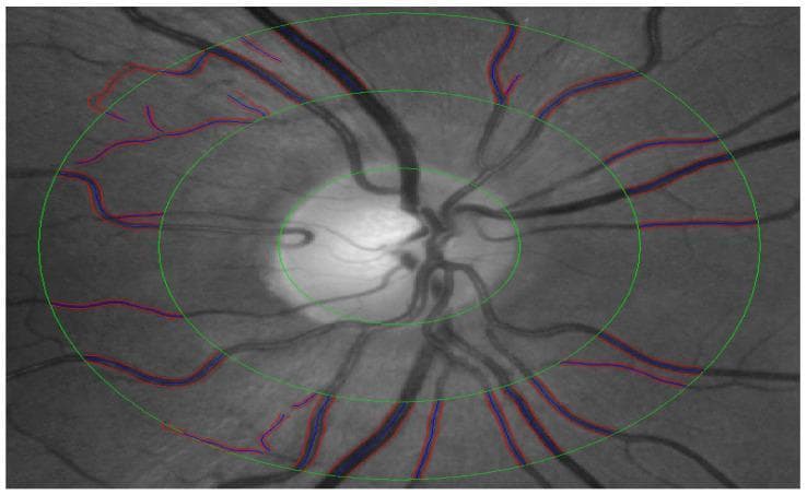This monochromatic fundus photograph captures the optic nerve head (ONH) and surrounding retinal vasculature, specifically demonstrating the semi-automated grading of retinal vessels. The optic disc is centrally positioned, appearing as a bright, circular structure from which retinal arteries and veins emerge and branch into the periphery. Overlaid on the image are three concentric green rings centered on the ONH, spaced at intervals of 0.5 and 1.0 disc diameters (DD) from the disc margin. These rings define the standardized zones for measuring the Central Retinal Artery Equivalent (CRAE) and Central Retinal Vein Equivalent (CRVE). Within the outer measurement zone, specific vascular segments are traced with blue and red colored lines, indicating the software-assisted identification and measurement of arteries and veins. This visual tool is essential for assessing the Arteriole-to-Venule Ratio (AVR), a key clinical marker in evaluating systemic cardiovascular health, hypertensive retinopathy, and microvascular changes associated with metabolic diseases.