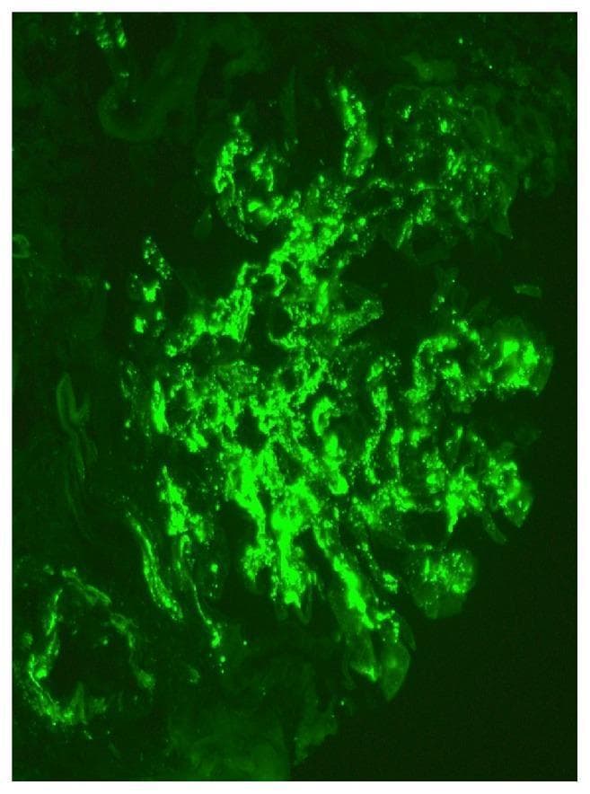 This diagnostic image is a high-magnification (x400) immunofluorescence microscopy of a renal biopsy specimen. The visual field demonstrates a single glomerulus exhibiting a classic pathological pattern of intense, apple-green fluorescent staining. The primary finding is the global, 3+ intensity mesangial deposition of immunoglobulin A (IgA). The deposits are characterized by a granular and confluent distribution primarily restricted to the mesangial matrix and stalk regions of the glomerular tuft, highlighting the branched architecture of the mesangium. There is a notable absence of significant capillary loop or basement membrane staining, which is highly characteristic of IgA nephropathy (Berger disease). The surrounding renal parenchyma is dark, providing high contrast to the localized immunocomplex accumulation within the glomerular architecture. This diagnostic finding is a hallmark educational example used to confirm the diagnosis of primary IgA nephropathy or Henoch-Schönlein purpura nephritis in clinical pathology.