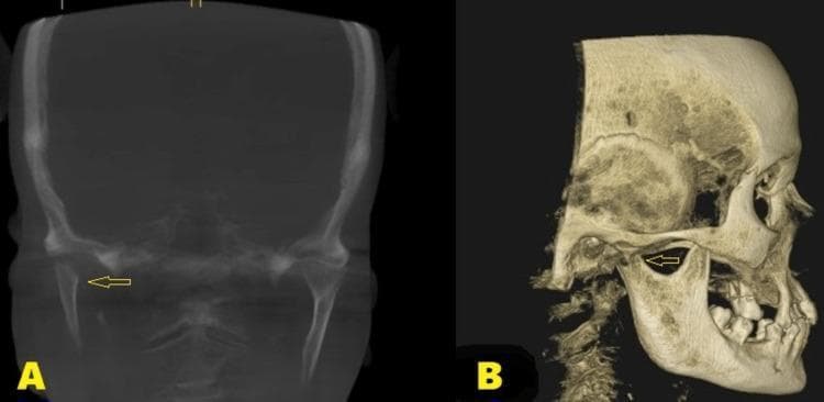 Postoperative cone beam computed tomography (CBCT) images of the maxillofacial region in a patient following a surgical condylectomy of the right mandible. Panel A displays a coronal section illustrating the absence of the right medial pole of the mandibular condyle. The surgical site exhibits smooth, well-defined bony margins (indicated by an arrow) with no evidence of irregular calcification or sequestration, suggesting healthy bone remodeling and wound healing. Panel B presents a three-dimensional sagittal reconstruction of the skull, providing a lateral view of the temporomandibular joint (TMJ) area. The 3D rendering (indicated by an arrow) confirms the anatomical alteration following the excision of the fractured condylar head, demonstrating the postoperative gap between the mandibular ramus and the glenoid fossa. These images are used in oral and maxillofacial surgery to evaluate the results of surgical intervention for condylar fractures and to monitor the long-term integrity of the joint space and mandibular function.