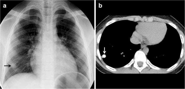 This dual-modality clinical imaging set illustrates a Ghon focus in a 7-year-old pediatric patient, characteristic of primary tuberculous infection. Panel A is an anteroposterior (AP) chest radiograph showing a subtle, well-defined, solitary nodular opacity in the peripheral right lower lung field (indicated by a black arrow). The surrounding pulmonary parenchyma, hilar structures, and cardiomediastinal silhouette appear unremarkable, without evident lymphadenopathy or pleural effusion. Panel B displays a non-contrast axial chest CT image at the level of the lower lobes, confirming the presence of a small, hyperdense, calcified pulmonary nodule in the right lower lobe (white arrow). The high attenuation value on CT indicates a healed or dormant granulomatous process. This visual finding is a classic representation of a Ghon focus, a localized area of parenchymal inflammation that has undergone caseating necrosis and subsequent calcification. This imaging is highly relevant for pediatric pulmonology and infectious disease education, demonstrating the typical radiological appearance of latent tuberculosis and the primary complex.