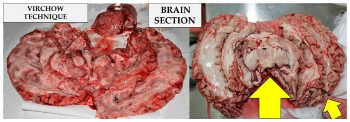 This clinical photograph displays two side-by-side gross pathology sections of a human brain using the Virchow technique during an autopsy. The left panel shows the brain dissected into several segments, exhibiting a variegated red to pinkish-tan appearance with visible vascular structures and blood pooling typical of fresh tissue. The right panel displays a more organized hemisphere-like section, highlighting the cerebral cortex, gyri, and sulci with greater clarity. A prominent yellow arrow points to the midbrain/brainstem region, indicating a specific site of interest or incision. The Virchow method is an anatomopathological technique characterized by sequential sagittal and coronal cuts, followed by bilateral 45-degree incisions into the hemispheres starting from the lateral ventricles. This visual comparison illustrates the procedural stages of brain resection for forensic or pathological examination, focusing on internal anatomy and the identification of potential lesions or intracranial hemorrhages.