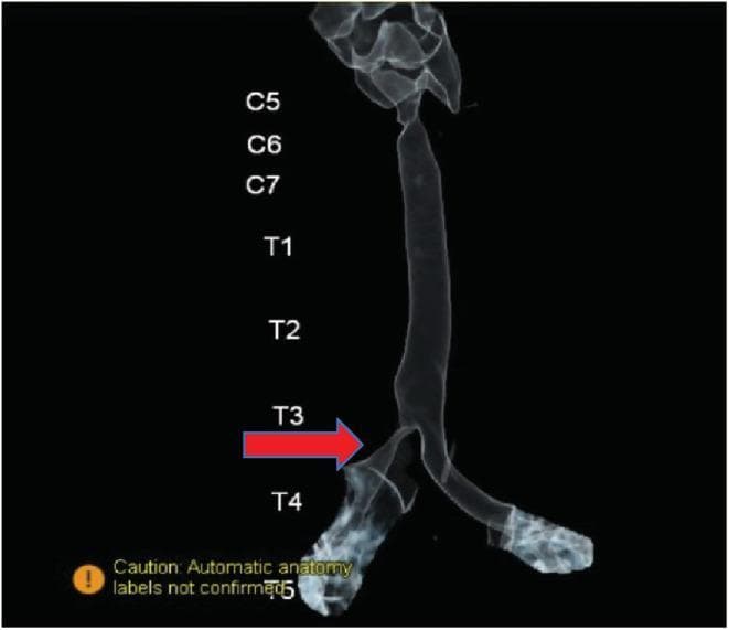This diagnostic image is a 3D reconstructed chest CT scan, also known as virtual bronchoscopy, showcasing the tracheobronchial tree. The visualization tracks the airway from the cervical region down to the main bronchi. Labels indicate vertebral levels from C5 to T5 to provide anatomical context. A prominent red arrow points to the level of the third thoracic vertebra (T3), highlighting a focal, significant partial narrowing or stenosis of the right main bronchus. In contrast, the left main bronchus maintains a normal caliber and patency. This image demonstrates the clinical application of 3D reconstruction in identifying structural airway anomalies, such as a bronchial web, by mapping internal lumen dimensions relative to bony landmarks. The image is used in medical education to teach diagnostic imaging techniques for respiratory obstructions and the anatomical relationship between the tracheobronchial tree and the spinal column.