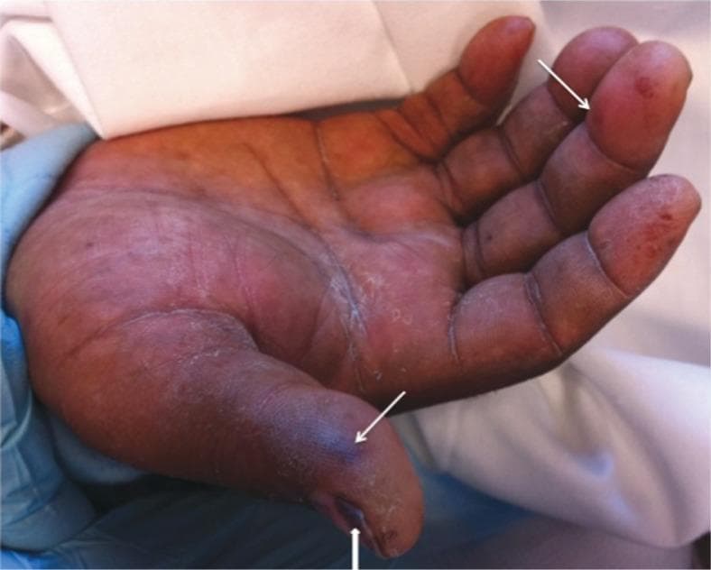 This clinical photograph shows the palmar surface of a right hand, illustrating classic peripheral stigmata of infective endocarditis. The image displays multiple Janeway lesions, which appear as pink-to-red, macular, irregularly shaped, and non-tender hemorrhagic spots. These lesions are notably prominent on the distal phalanx of the thumb and the middle finger (indicated by arrows). Additionally, a clear subungual splinter hemorrhage is visible as a dark, linear longitudinal streak under the nail bed of the thumb (indicated by an arrowhead). The skin also shows signs of generalized dryness and scaling. These visual findings are critical clinical indicators of septic emboli or immunologic phenomena associated with systemic infection, specifically infective endocarditis. The photograph serves as an educational tool for recognizing vascular manifestations during a physical examination in an acute care or cardiology context.