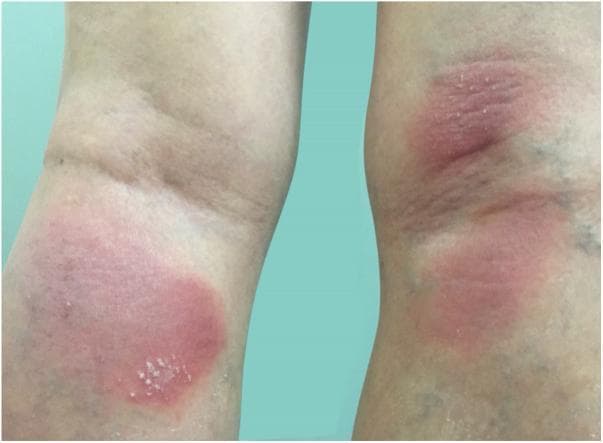 Clinical photograph of the posterior aspect of the lower limbs, specifically the popliteal fossae, demonstrating the early clinical presentation of generalized pustular psoriasis (GPP). The image shows well-demarcated, erythematous patches on both legs. Superimposed on the inflammatory red base are clusters of small, discrete, yellowish-white sterile pustules. The lesions are localized within the skin folds of the knees, exhibiting a symmetric distribution. The surrounding skin appears relatively normal, though some mild edema may be present within the plaques. This visual serves as an educational example of the initial eruptive phase of Von Zumbusch psoriasis, highlighting the pathognomonic feature of non-follicular pustulation on an erythematous background. The morphology and location are critical for distinguishing this systemic inflammatory condition from plaque-type psoriasis or acute bacterial infections like cellulitis.