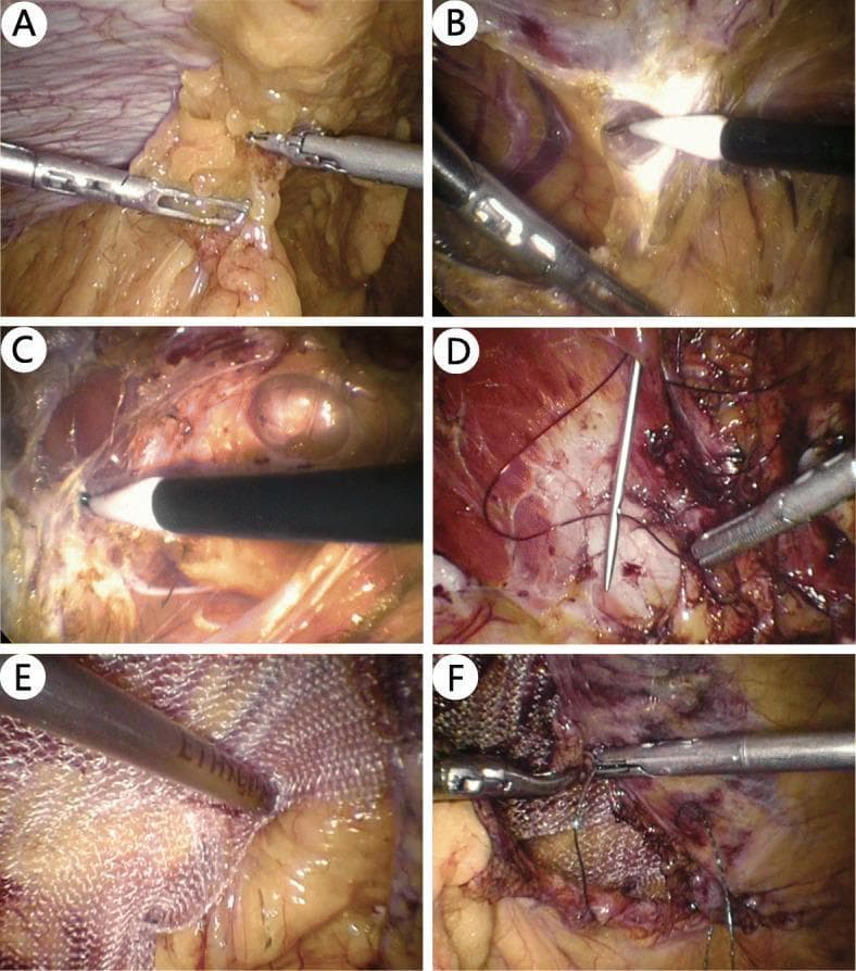This composite of six laparoscopic images (A-F) illustrates the sequential steps of the Transabdominal Sublay (TAS) procedure for ventral hernia repair. Image A shows initial laparoscopic adhesiolysis using graspers to clear the surgical field. In Image B, the peritoneum and posterior rectus sheath are incised to access the retromuscular plane. Image C demonstrates further blunt dissection of the retromuscular space to create sufficient room for mesh placement. Image D visualizes the closure of the primary hernia defect using a continuous suture technique with a surgical needle. In Image E, a synthetic polypropylene mesh with a characteristic woven texture is introduced and positioned within the dissected sublay space, ensuring adequate overlap of the defect margins. Finally, Image F shows the securing of the mesh and the closure of the peritoneal flap to exclude the mesh from the intraperitoneal cavity. This clinical series serves as an educational guide for surgeons on the laparoscopic transperitoneal approach to extraperitoneal space reinforcement.