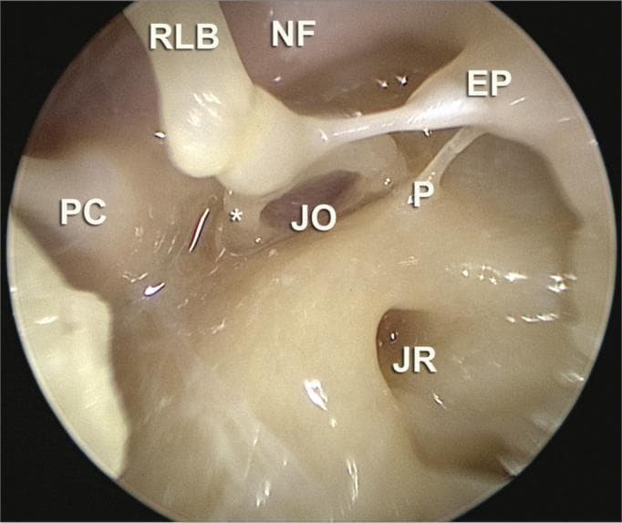 This endoscopic clinical photograph displays the detailed surgical anatomy of the middle ear (tympanic cavity) as viewed through a 30-degree scope during a stapes surgery anatomical dissection. The image provides a high-resolution view of the medial and posterior walls of the middle ear. Key visible landmarks include the long process of the incus (RLB) articulating with the stapes at the incudostapedial joint. The oval window niche (JO) and round window niche (JR) are clearly identified. Superior to the oval window niche, the facial nerve canal (NF) is visible as a smooth bony prominence. The pyramidal eminence (EP) is shown with the stapedius tendon extending toward the stapes. Additional anatomical features include the ponticulus (P), which is a bony ridge separating the oval window niche from the sinus tympani, and the cochleariform process (PC) on the anterior-superior aspect. This visual resource is essential for medical education regarding endoscopic ear surgery (EES) and middle ear microsurgery, demonstrating the spatial relationships required for procedures like stapedotomy or tympanoplasty.