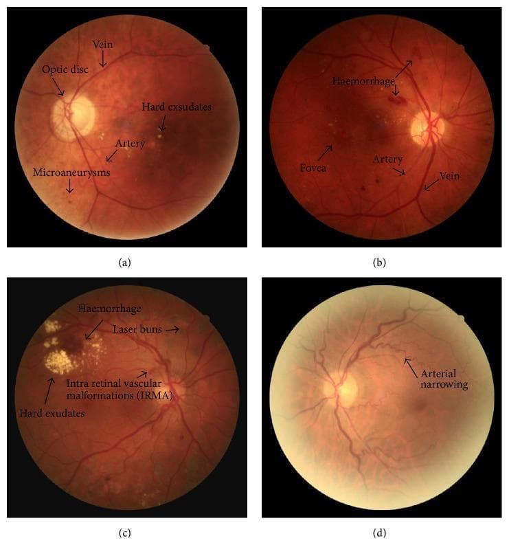 A multi-panel diagnostic image comprising four nonmydriatic fundus photographs (a-d) illustrating various stages of retinopathy. (a) Mild nonproliferative diabetic retinopathy (NPDR) with hypertensive features, showing discrete microaneurysms and scattered yellowish hard exudates. (b) Moderate NPDR characterized by a prominent intraretinal hemorrhage located superior to the optic disc and foveal region. (c) Proliferative diabetic retinopathy (PDR) following treatment, demonstrating characteristic laser photocoagulation burns, intraretinal microvascular abnormalities (IRMA), persistent hard exudates, and localized hemorrhage. (d) Grade I hypertensive retinopathy, primarily highlighting generalized arterial narrowing and vascular tortuosity. The images provide a clinical comparison of vascular changes, exudative processes, and sequelae of retinal ischemia and hypertension. Key anatomical landmarks including the optic disc, retinal arteries, veins, and fovea are annotated throughout the set to facilitate identification of pathological distributions.
