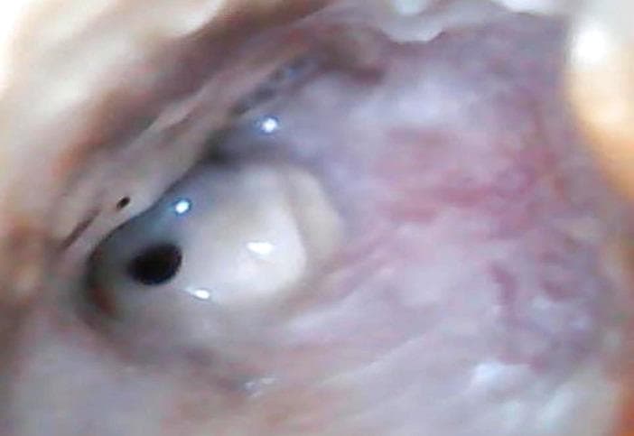 This clinical photograph displays an otoscopic view of the right ear, highlighting pathological findings of the external auditory canal (EAC) and tympanic membrane. The EAC shows significant inflammatory changes, characterized by diffuse erythema and edema of the canal walls. Visible purulent secretions are present within the lumen, suggesting an active infectious process such as chronic suppurative otitis media or acute exacerbation. The tympanic membrane is clearly visualized and exhibits a single, well-defined perforation located in the anterior-inferior quadrant. The perforation appears as a dark, circular opening amidst the remaining translucent, light-reflective portions of the membrane. Normal landmarks like the handle of the malleus are obscured by the surrounding inflammatory tissue and exudate. This image serves as a clinical example of suppurative middle ear disease with associated tympanic membrane rupture and secondary external canal inflammation, relevant for otolaryngology training in diagnostic otoscopy.