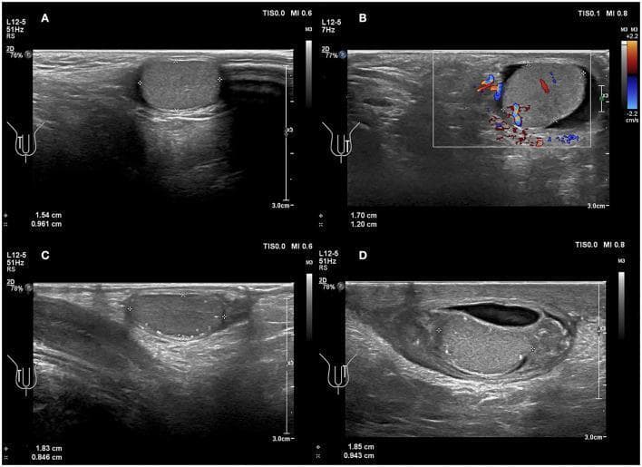 This diagnostic imaging panel consists of four scrotal ultrasound images (A-D) demonstrating comparison between normal and torsed pediatric testicles. Images A and C serve as controls, showing a normal testicle with homogeneous parenchymal echotexture and a vertical axial orientation. Images B and D display clinical findings of testicular torsion. Image B is a Color Doppler ultrasound from a 6-year-old boy showing a horizontal change in the testicular axial direction with preserved internal blood flow, suggesting incomplete or early torsion. Images C and D focus on an 8-year-old boy; image D illustrates advanced torsion with a distinct change in the axial orientation of the testicle and testicular mediastinum, accompanied by heterogeneous parenchymal echogenicity and an anechoic peritesticular fissure (reactive hydrocele). These visual markers—specifically horizontal lie (bell-clapper deformity) and altered echotexture—are critical diagnostic indicators for testicular torsion in pediatric patients, even when blood flow is intermittently detected.