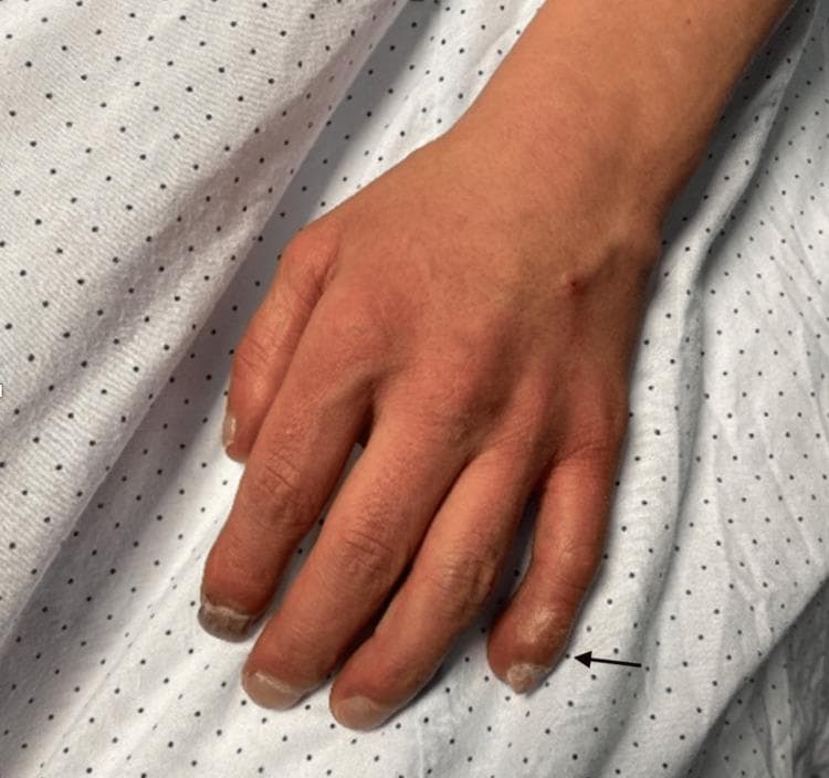 This clinical photograph displays a dorsal view of a human hand illustrating digital clubbing (Hippocratic fingers). The distal phalanges of the fingers show bulbous enlargement and soft tissue swelling, most prominently at the index and middle fingers. The nail beds exhibit significant longitudinal and transverse hypercurvature, giving the nails a 'watch-glass' appearance. There is a visible loss of the Lovibond angle (the normal angle between the nail plate and the proximal nail fold). An arrow indicates the distal phalanx of the fourth digit to emphasize these structural changes. The skin of the hand demonstrates a diffuse erythematous or dusky hue, clinically consistent with secondary polycythemia or chronic cyanosis. This visual finding is a classic diagnostic sign often associated with chronic hypoxemia, cyanotic congenital heart disease (such as Eisenmenger syndrome), or chronic pulmonary disease. The image serves as an educational reference for physical examination findings in cardiovascular and respiratory medicine.