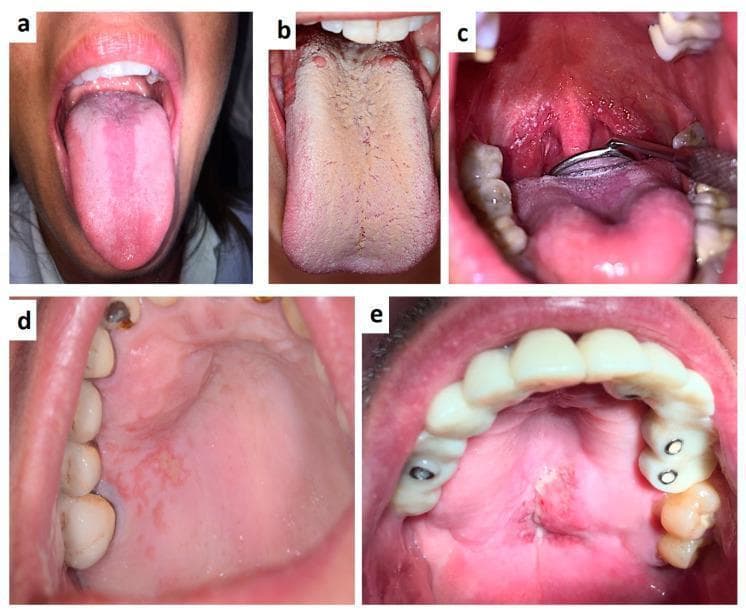 This composite of clinical intraoral photographs illustrates various oral manifestations associated with HIV infection and immunocompromised states. (a) Displays median rhomboid glossitis, appearing as a depapillated, erythematous longitudinal band on the dorsal midline of the tongue. (b) Shows pseudomembranous candidiasis (thrush) characterized by a thick, confluent, creamy-white coating across the dorsal tongue surface. (c) Depicts oropharyngeal candidiasis and herpetic-like ulcerations on the soft palate and tonsillar pillars, with visible dental prosthetics. (d) Shows an irregular herpetic lesion on the hard palate presenting as grouped erosions and erythematous patches. (e) Exhibits a large, ulcerated, and necrotizing lesion on the hard palate consistent with non-Hodgkin lymphoma in an HIV-positive patient; the maxillary arch shows extensive dental rehabilitation, including a bridge and several crown restorations. These images serve as educational markers for opportunistic infections and malignancies that frequently act as early clinical indicators of systemic immunosuppression.