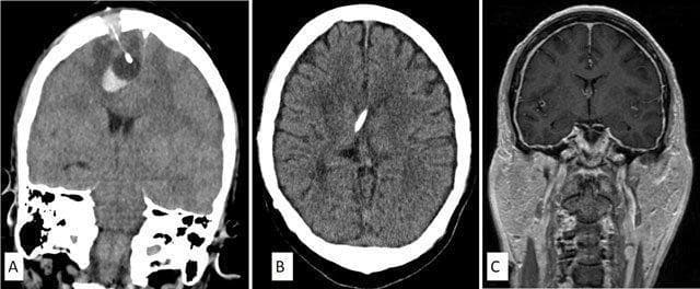 This composite figure consists of three diagnostic images illustrating complications from intracranial devices. Image A is a coronal non-contrast CT scan showing a linear, hyperdense intracranial pressure (ICP) monitoring probe inserted into the right frontal lobe. At the distal tip of the probe, a localized hyperdense ovoid area indicates an acute intraparenchymal hematoma. Image B is an axial CT scan showing a right parietal ventriculoperitoneal (VP) shunt catheter with its tip abutting the septum pellucidum. The lateral ventricles appear markedly compressed or 'slit-like.' Image C is a coronal post-contrast T1-weighted MRI demonstrating persistent slit-like ventricles and diffuse pachymeningeal (dural) thickening and enhancement. These findings are clinically diagnostic of intracranial hypotension resulting from cerebrospinal fluid (CSF) over-drainage via the shunt. This collection serves as an educational resource for identifying hardware-related complications, including placement-induced hemorrhage and shunt-induced hypotension.