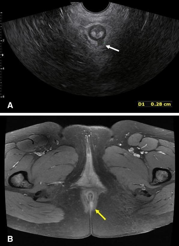 A comparative diagnostic image display showing a Type II anal fistula through two different imaging modalities: (A) a transverse pelvic 3D Ultrasound (US) and (B) an axial Magnetic Resonance Image (MRI). In image A, the 3D ultrasound demonstrates the fistula as a hypoechoic (dark) focal area within the heterogeneous pelvic floor tissue, indicated by a white arrow; a caliper measurement 'D1' shows a width of 0.28 cm. In image B, the MRI (likely T2-weighted or STIR) reveals the fistula as a hyperintense (bright) linear structure, indicated by a yellow arrow, situated within the midline anatomical structures near the anal canal. The surrounding pelvic floor musculature, including the levator ani and external sphincter regions, are visible as darker, well-defined tissues. This comparison illustrates the diagnostic visualization of perianal inflammatory tracks and is used in colorectal surgery planning for classification and localization of fistulous tracts relative to the sphincter complex.