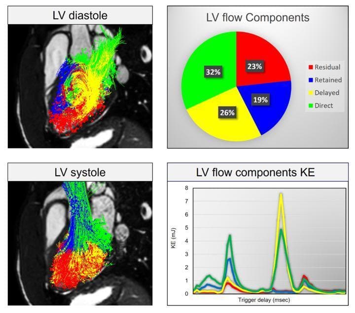 This composite educational graphic illustrates a 4D flow cardiac magnetic resonance (CMR) analysis of blood flow components in the left ventricle (LV). The top-left and bottom-left panels display long-axis diagnostic images with color-coded streamline visualizations. 'LV diastole' shows a swirling pattern of dispersed flow components, while 'LV systole' depicts a directed, streamlined ejection of blood toward the outflow tract. The top-right panel is a pie chart quantifying LV flow components: Direct flow (32%, green), Delayed flow (26%, yellow), Residual flow (23%, red), and Retained flow (19%, blue). The bottom-right panel is a line graph plotting kinetic energy (KE in mJ) against trigger delay (msec). It demonstrates hemodynamic peaks throughout the cardiac cycle, with Delayed (yellow) and Direct (green) flow components reaching the highest peak kinetic energies during late diastole/early systole. This tool is clinically relevant for assessing intraventricular energetics and risk-stratifying patients with cardiovascular disorders such as myocardial infarction or cardiomyopathy.