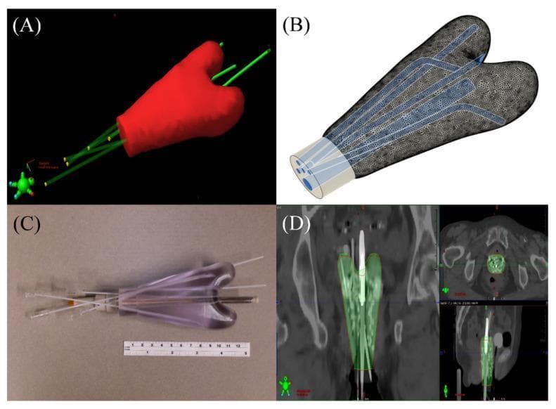 This composite educational graphic illustrates the development and validation of a patient-specific 3D-printed vaginal template for gynecological brachytherapy. (A) A 3D digital model showing the contoured vaginal space in red, integrated with green cylindrical tracks for interstitial needles and a central tandem. (B) A wireframe mesh visualization of the template design, highlighting internal channels for Direction Modulated Brachytherapy (DMBT) and needle placement. (C) A clinical photograph of the physical 3D-printed template, manufactured from transparent medical-grade photopolymer, with the DMBT tandem and interstitial needles inserted. A ruler is included for scale. (D) Radiologic image registration panels showing the 3D-printed applicator (highlighted in green) overlaid on planning CT scans in axial, coronal, and sagittal planes to confirm geometric accuracy and anatomical fit. The material demonstrates the workflow for improving dose conformality in treating locally advanced cervical cancer using personalized, intensity-modulated brachytherapy applicators.