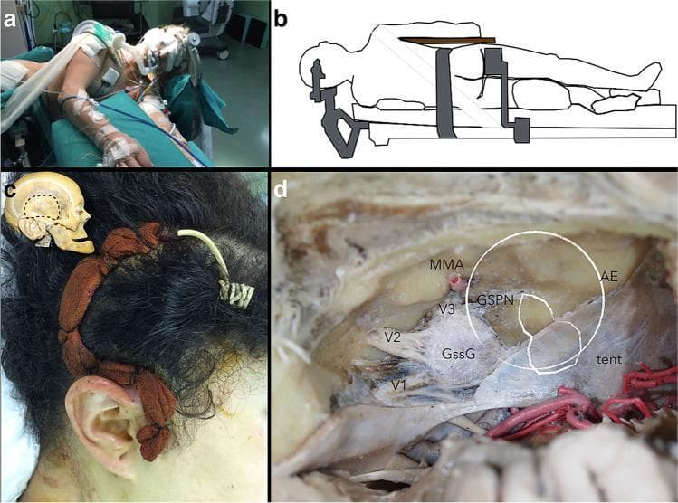 A multi-panel medical figure demonstrating surgical positioning and middle fossa neuroanatomy for a middle fossa approach (MFA). Panel A (Clinical Photograph) and B (Schematic Illustration) show a patient in the left lateral decubitus position for neurosurgery. The head is slightly extended toward the contralateral side with the ipsilateral shoulder retracted inferiorly to optimize the surgical corridor. Panel C displays a 'question mark' parieto-temporal skin incision behind the ear, with an inset skull diagram showing the underlying craniotomy boundaries. Panel D is a Cadaveric Specimen showing the superior view of the middle cranial fossa floor after dural peeling. Key anatomical landmarks are labeled: the Gasserian ganglion (GssG) and its divisions (V1, V2, V3); the greater superficial petrosal nerve (GSPN) running anteriorly; the middle meningeal artery (MMA) emerging from the foramen spinosum; and the arcuate eminence (AE) indicating the superior semicircular canal. A white outline simulates the relative location of a facial nerve schwannoma within the 'rhomboid construct' of the petrous bone, highlighting its relationship to the tentorium cerebelli (tent) and trigeminal complex.