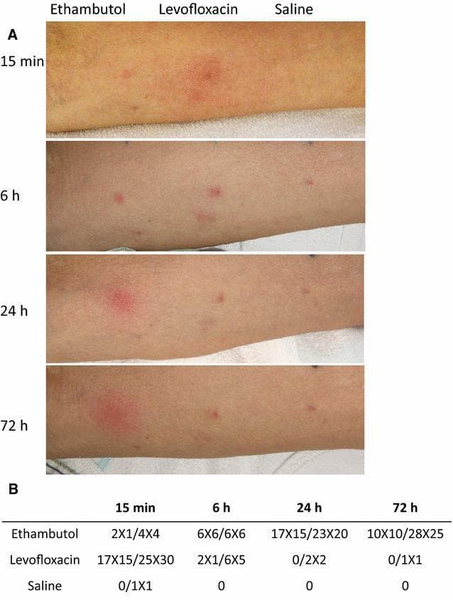 Educational clinical image and data table illustrating types of drug hypersensitivity reactions. Part A displays four sequential clinical photographs of a patient's forearm following intradermal skin testing with Ethambutol, Levofloxacin, and Saline (negative control) over a 72-hour period. At 15 minutes, Levofloxacin shows a significant erythematous wheal and flare reaction, characteristic of Type I IgE-mediated immediate hypersensitivity, which diminishes by 6 hours. In contrast, Ethambutol demonstrates a late-phase reaction (LPR), with minimal initial changes progressing to significant indurative erythema and edema that peaks at 24 hours and persists through 72 hours. Part B provides a quantitative data table measuring the diameters (in mm) of the wheal and induration/erythema at each time point (15 min, 6 h, 24 h, and 72 h), correlating clinical visuals with objective diagnostic measurements. This material is used to teach the temporal differences between immediate hypersensitivity and late-phase or delayed-type hypersensitivity reactions in clinical allergy and immunology.