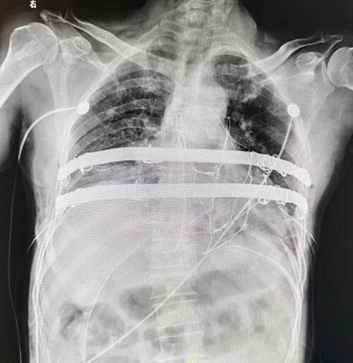 Postoperative anterior-posterior (AP) chest X-ray demonstrating surgical reconstruction of the anterior chest wall following a sternal tumor resection. The image shows two prominent, radiopaque horizontal steel bars positioned parallel across the central thoracic region. These bars are part of a 'Wenlin procedure' used for chest wall stabilization, with their distal ends anchored to adjacent ribs. Fine radiopaque steel wires are visible, forming a mesh-like configuration between the bars and the surrounding ribs to provide structural reinforcement to the resection site. Multiple medical devices are present, including bilateral thoracic drainage tubes extending toward the lower thorax and ECG leads on the upper chest. The skeletal structure shows a clear absence of the central sternal body, indicating the extent of the surgical resection. This diagnostic image illustrates complex thoracic reconstruction techniques using metallic implants to restore chest wall integrity and maintain respiratory mechanics.