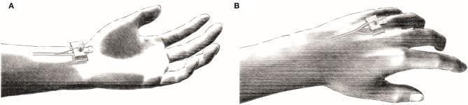 A two-panel medical illustration demonstrating the anatomical sites for invasive vascular catheterization. Panel A (Arterial Catheter): Shows the placement of an arterial line in the radial artery. The insertion point is located on the volar (palmar) surface of the wrist, proximal to the thenar eminence. The catheter is secured with a specialized transparent adhesive dressing and reinforcement strips, with the pressure monitoring tubing extending proximally along the forearm. Panel B (Venous Catheter): Depicts the cannulation of the dorsal venous network (rete venosum dorsale manus) on the back of the hand. The venous catheter is shown inserted into a superficial vein over the metacarpals, secured with a similar fixation device and adhesive tape, with the line running proximally toward the wrist. These procedures are typically performed for continuous invasive pressure monitoring and repeated blood gas analysis (BGA) in clinical research or critical care settings. The illustration highlights standard aseptic securement techniques and regional anatomy pertinent to anesthesia and intensive care medicine.