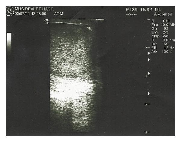 This diagnostic image is a B-mode grayscale scrotal ultrasound from a patient with brucellar epididymo-orchitis (BEO). The scan displays a longitudinal view of the testis, characterized by a predominantly homogeneous, finely granular speckled echotexture. In the lower central portion of the testicular parenchyma, there is a distinct, ill-defined region of increased echogenicity (hyperechoic area), which may correspond to inflammatory changes or an evolving focal lesion common in infectious orchitis. On-screen technical parameters include a 10.0 MHz high-frequency linear transducer setting, a depth of 8.0 cm, and a gain of 92, optimized for superficial soft tissue visualization. The image is part of a clinical evaluation to differentiate between inflammatory conditions like testicular abscesses and solid masses. This visual is significant for students and clinicians studying urogenital infections and the sonographic manifestations of epididymo-orchitis.
