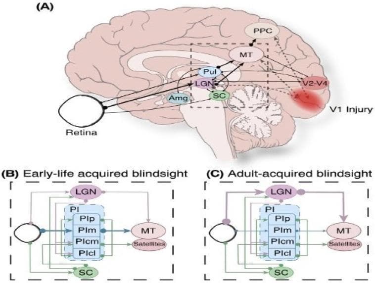 Educational diagram illustrating the neuroanatomical pathways of subcortical vision and blindsight following primary visual cortex (V1) injury. (A) A medial view of the human brain shows retinal projections to the amygdala (Amg), lateral geniculate nucleus (LGN), and superior colliculus (SC). Secondary pathways extend from the LGN to visual areas V2-V4, the middle temporal area (MT), and the posterior parietal cortex (PPC). A red-shaded region indicates V1 injury, with dashed lines representing resulting neuronal degeneration. (B, C) Comparative flowcharts illustrate hypothesized pathways for early-life versus adult-acquired blindsight. These diagrams detail the circuit between the retina, SC, LGN, and subdivisions of the inferior pulvinar (PIp, PIm, PIcm, PIcl) projecting to the MT area. Line thickness indicates relative projection strength, highlighting increased connectivity and plasticity in the pediatric brain (B) compared to the adult brain (C). This illustration serves to explain compensatory mechanisms in visual perception despite cortical damage.