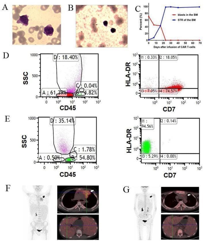 A multi-panel figure illustrating the therapeutic response of early T-cell precursor acute lymphoblastic leukemia/lymphoma (ETP-ALL/LBL) to CD7 CAR T-cell infusion. Panels A and B show bone marrow (BM) morphology, transitioning from hypercellular with prominent blasts (A) to hypocellular without visible blasts (B). Panel C is a line graph tracking the sharp decline of BM blast percentage and the simultaneous rise of donor chimerism (STR) to nearly 100% within 30 days. Panels D and E represent flow cytometry analysis of BM cells before and after treatment. D shows a large population of CD45-dim blasts (Region A: 61.39%) that are CD7-positive. E demonstrates the elimination of these blasts (Region A: 0.50%) and the emergence of CD7-negative populations (Region B: 54.80%) and CD3-positive/CD7-negative T-cells. Panels F and G display FDG PET-CT scans. The 'before' scan (F) reveals extensive hypermetabolic extramedullary disease, including a large mediastinal mass and widespread lymphadenopathy. The 'after' scan (G) shows a complete metabolic response with the disappearance of the mediastinal mass and resolution of hypermetabolic lesions across cervical, mediastinal, and abdominal regions.