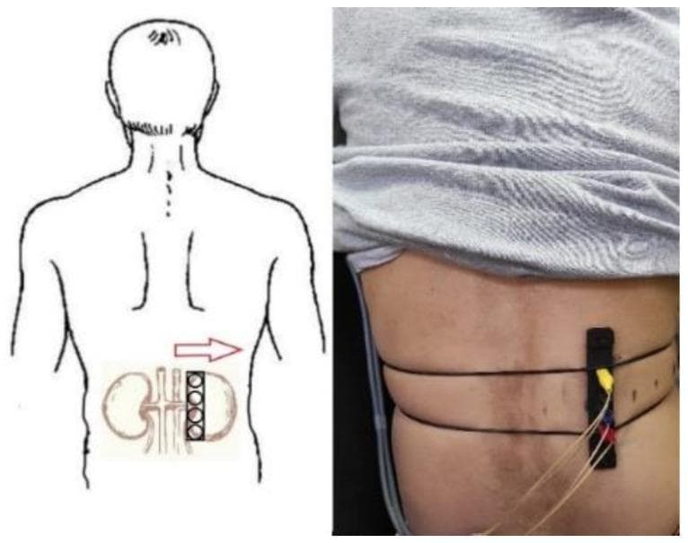 This dual-panel image demonstrates the clinical application of a tetrapolar electrode system for bio-impedance measurement of renal blood flow. The left panel is an anatomical diagram showing a posterior view of the human torso. It illustrates the schematic positioning of two kidneys in the lumbar region, with a tetrapolar electrode array (four circular contacts in a rectangular housing) projected over the right kidney. A horizontal arrow indicates the potential shift for mapping. The right panel is a clinical photograph showing the actual setup on a male subject. A black rectangular electrode patch with four contacts is affixed to the right flank. It is secured by thin, dark elastic bands wrapped around the waist to ensure stable skin contact. Multiple colored lead wires (yellow, blue, and red) emerge from the electrode housing. This side-by-side comparison illustrates the translation of theoretical anatomical targeting into practical non-invasive monitoring for renal hemodynamics and potential assessment of acute kidney injury.