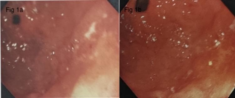 Comparison of two upper gastrointestinal endoscopy (UGIE) frames of the gastric antrum, labeled Figure 1a and Figure 1b, documenting the progression of a gastric ulcer. Figure 1a shows the initial presentation of a gastric ulcer located along the lesser curvature, characterized by the presence of an adherent clot, consistent with a Forrest class IIb bleeding classification. The surrounding mucosa displays patchy erythema. Figure 1b, captured two days post-intervention, shows the same ulcer at the incisura now featuring a clean base without an adherent clot, corresponding to Forrest class III. The surrounding gastric tissue exhibits signs of induration and persistent erythema. These images illustrate the diagnostic and monitoring utility of endoscopy in assessing upper gastrointestinal bleeding and the evolution of peptic ulcer disease in the context of H. pylori-positive gastritis.