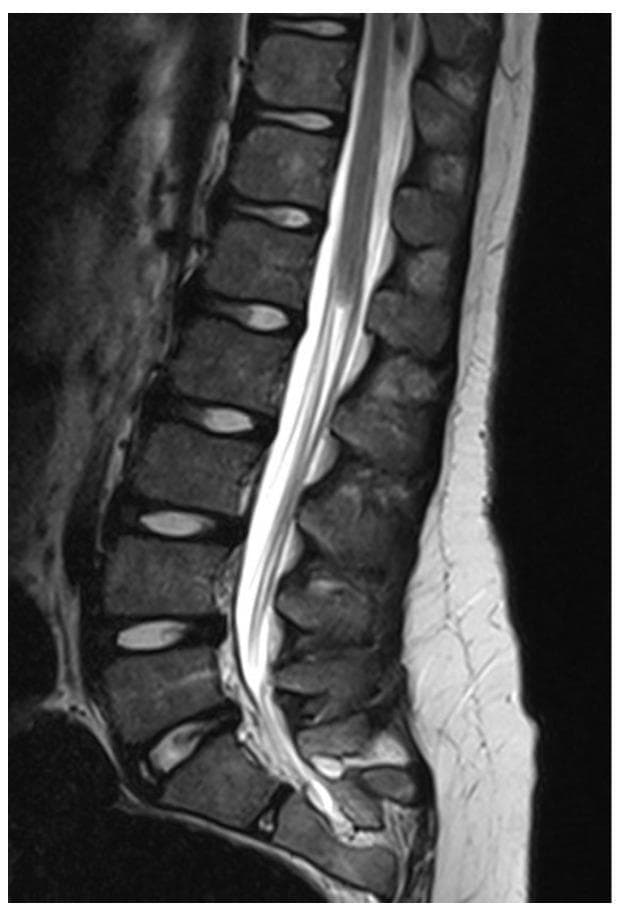 This diagnostic image is a T2-weighted sagittal MRI of the lumbosacral spine demonstrating a classic presentation of caudal regression syndrome. The imaging shows a blunt, high-riding termination of the spinal cord (conus medullaris) above the expected physiological level. There is a notable absence of the distal nerve roots of the cauda equina and the filum terminale within the lower thecal sac, which appears filled only with hyperintense cerebrospinal fluid (CSF). The lumbar vertebral bodies maintain relatively normal rectangular morphology and alignment; however, there is evidence of sacral dysgenesis or partial agenesis inferiorly. This finding is characteristic of a failure in the process of secondary neurulation, leading to complete agenesis of the caudal neural elements. The visual evidence supports a diagnosis associated with occult spinal dysraphism and significant clinical implications for lower limb and sphincter function.