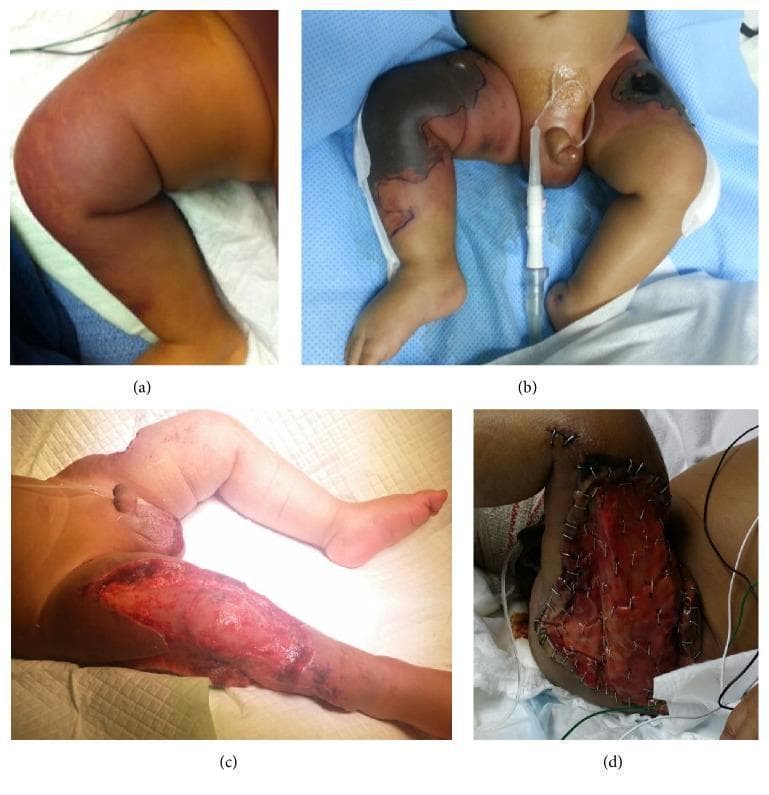 A series of four clinical photographs (a-d) documenting the rapid progression and surgical management of purpura fulminans in an infant. Panel (a) displays early reddish-purple discoloration and induration on the thigh. Panel (b) shows the evolution into extensive hemorrhagic necrosis, characterized by sharply demarcated, blackened eschar on the lower extremities and groin. Panel (c) illustrates the post-operative state following emergency fasciotomy and surgical debridement for compartment syndrome, revealing a deep, open wound with exposed subcutaneous tissues and muscle. Panel (d) demonstrates the application of an artificial dermal regeneration template (Integra) over the debrided area, secured with surgical staples to prepare the wound bed for future grafting. This sequence serves as a clinical teaching tool for recognizing life-threatening thrombotic skin necrosis associated with protein C deficiency and DIC, as well as the multidisciplinary surgical approach involving tissue debridement and dermal substitutes.