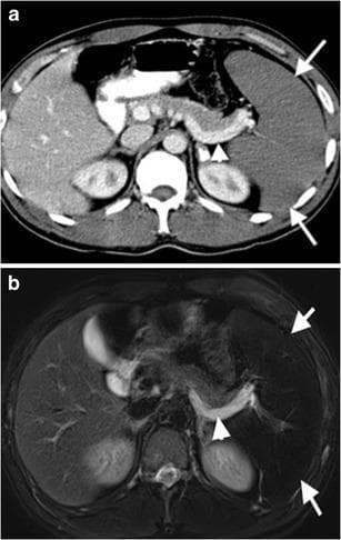 Diagnostic axial images of the upper abdomen in a 26-year-old male demonstrate findings characteristic of Acute Splenic Sequestration Crisis (ASSC) in the setting of sickle cell-thalassemia. Panel (a) is a contrast-enhanced axial CT showing significant splenomegaly with a complete lack of parenchymal enhancement (arrows), indicating severe hypoperfusion. Notably, there is visualization of the splenic vein (arrowhead) through retrograde filling from the portal vein. Panel (b) is a corresponding axial T2-weighted MRI. The splenic parenchyma appears markedly hypointense (arrows), consistent with chronic iron deposition from repeated hemolysis or transfusions. The splenic vein (arrowhead) displays high signal intensity (hyperintense), a radiological sign of slow or stagnant blood flow resulting from the altered hemodynamics of retrograde venous filling. These findings illustrate the vascular compromise and massive blood pooling associated with splenic sequestration crises in patients with hemoglobinopathies.