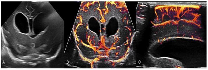 This composite of neonatal cranial ultrasound images illustrates post-hemorrhagic hydrocephalus in a 22-day-old preterm infant. Image A is a grayscale coronal view showing marked symmetric dilatation of the lateral ventricles (hydrocephalus) with internal echogenic material representing layering blood products from a prior intraventricular hemorrhage. Images B and C utilize advanced microvascular Doppler imaging to map slow-flow cerebral vessels. Image B (coronal) and Image C (sagittal) display these microvessels using a velocity-coded color scale, where yellow indicates relatively higher flow velocities and orange-to-red indicates slower flow. The images demonstrate the spatial distribution of the cerebral microvasculature in relation to the enlarged ventricles, providing a visual assessment of cerebral perfusion. This educational material highlights the diagnostic utility of combining conventional grayscale ultrasound for structural evaluation with microvascular imaging to monitor hemodynamic changes associated with increased intracranial pressure in neonatal hydrocephalus.