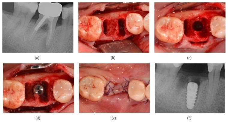 This composite figure illustrates a timeline of immediate implant placement for a mandibular first molar. (a) Preoperative periapical radiograph shows a tooth with an endodontic post and crown, exhibiting periapical radiolucency. (b) Intraoperative clinical photograph displays the multi-rooted post-extraction socket with visible alveolar bone architecture and marginal gingival retraction. (c) Clinical view showing the osteotomy site prepared within the interradicular bone of the extraction socket. (d) Direct visualization of the dental implant body seated within the prepared site, positioned below the crestal bone level. (e) Post-surgical clinical view demonstrating primary wound closure achieved with blue non-resorbable monofilament sutures in a cross-mattress pattern over the surgical site. (f) Postoperative periapical radiograph confirming the final vertical and horizontal positioning of the radiopaque, threaded tapered implant within the mandibular alveolar bone. This sequence demonstrates the surgical protocol for immediate implant placement following tooth extraction in oral implantology.