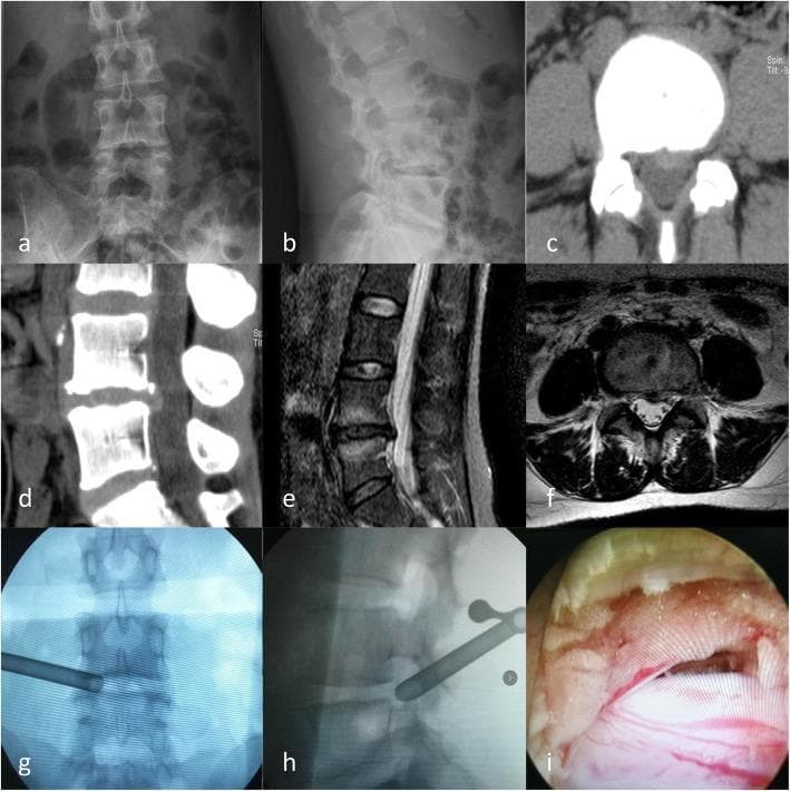 A multi-modal imaging series and clinical photograph detailing a lumbar disc herniation and its surgical management. (a-b) Preoperative lumbar X-rays in anteroposterior and lateral views showing spinal alignment and vertebral anatomy. (c-d) CT scans in axial and sagittal planes demonstrate a focal disc protrusion in the posterior left portion of the L4/5 intervertebral disc. (e-f) MRI scans (T2-weighted) confirm the L4/5 left-sided disc herniation, showing significant compression of the left L5 nerve root within the spinal canal. (g-h) Intraoperative fluoroscopic X-rays (anteroposterior and lateral) visualize the precise placement of a percutaneous endoscopic lumbar discectomy (PELD) working channel at the L4/5 level. (i) An endoscopic clinical photograph provides a direct visualization of the exposed left L5 nerve root following decompression. The collection serves as an educational sequence from diagnostic imaging through surgical intervention for lumbar radiculopathy.