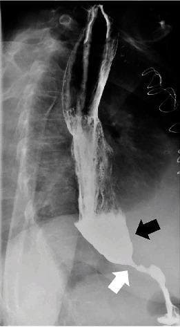 This diagnostic image is a barium swallow fluoroscopy (X-ray radiography) of the upper gastrointestinal tract, specifically the esophagus and stomach. The image demonstrates classic radiological features of achalasia. There is marked dilation of the distal esophagus, which is filled with an opaque accumulation of pooled barium contrast (indicated by the black arrow). At the gastroesophageal junction, there is a smooth, abrupt tapering of the esophageal lumen, creating a 'bird's beak' deformity (indicated by the white arrow) representing the failure of the lower esophageal sphincter (LES) to relax. Minimal contrast is seen trickling into the stomach, indicating delayed bolus transit. The study illustrates the secondary effects of aperistalsis and LES dysfunction on esophageal morphology and emptying. This material is highly relevant for medical education in gastroenterology and radiology for identifying esophageal motility disorders and obstructive pathologies at the gastroesophageal junction.