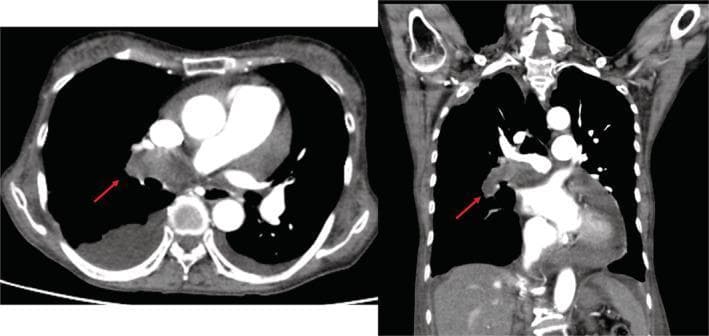 This diagnostic image consists of two panels showing a thoracic contrast-enhanced computed tomography (CT) scan in axial (left) and coronal (right) views. A red arrow in both views points to a prominent, low-attenuation space-occupying lesion located within the right pulmonary artery, extending toward the hilum. This finding is characteristic of a central pulmonary thrombus or embolism, appearing as a filling defect that obstructs the contrast-filled vessel lumen. Additional clinical findings include a large right-sided pleural effusion, visible as a crescentic fluid collection in the posterior-dependent portion of the right hemithorax on the axial view. The heart appears enlarged, consistent with cardiomegaly and potential right heart strain associated with chronic thromboembolic pulmonary hypertension (CTEPH). The image serves as an educational example of central pulmonary vascular pathology and its secondary effects on the thoracic cavity, such as pleural effusion and cardiac remodeling.