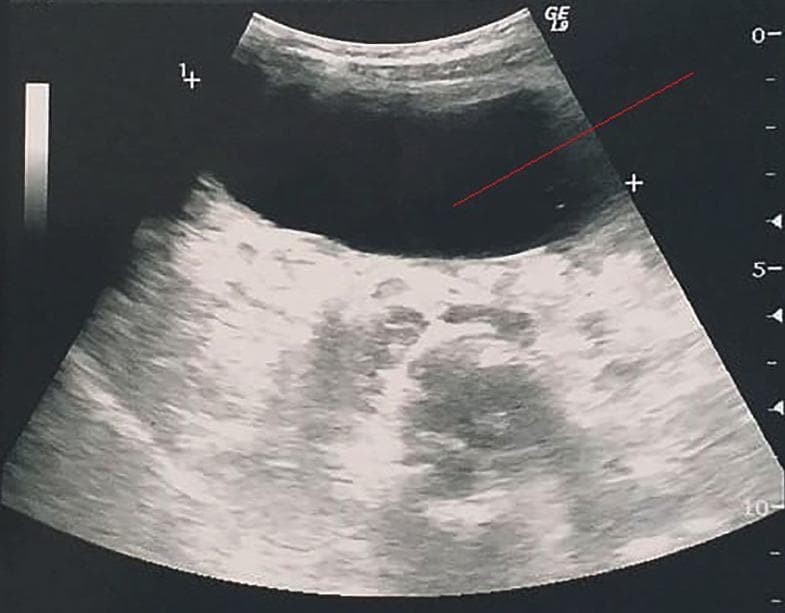 This abdominal ultrasonography (B-mode) demonstrates a large, well-defined cystic lesion within the peritoneal cavity, likely representing a primary peritoneal hydatid cyst (echinococcosis). The mass is predominantly anechoic, indicating a fluid-filled interior, with a smooth, regular wall. Significant posterior acoustic enhancement is visible distal to the cyst, which is a classic diagnostic feature of fluid-containing structures. The internal architecture reveals subtle, low-level echoes (hydatid sand or debris) settling in the dependent posterior portion of the cyst. The lesion exerts a mass effect, evidenced by the compression and displacement of adjacent heterogeneous soft tissues in the mesenteric or pelvic region. No internal septations or daughter cysts are clearly visible in this specific plane, characterizing it as a WHO type CE1 cyst. This image is an educational example of parasitic peritoneal disease and the use of diagnostic ultrasound for characterizing cystic abdominal masses.
