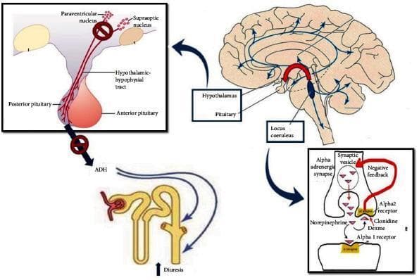 This pathophysiology diagram illustrates the neural and endocrine pathways involved in dexmedetomidine-induced central diabetes insipidus. The graphic features four interconnected panels: 1) A sagittal brain illustration showing the locus coeruleus projecting noradrenergic pathways to the hypothalamus and cortex. 2) A detailed view of the hypothalamic-hypophysial tract, highlighting the paraventricular and supraoptic nuclei. A prohibition sign over the tract indicates impaired signaling to the posterior pituitary, resulting in decreased Antidiuretic Hormone (ADH) release. 3) A molecular view of an alpha-adrenergic synapse where dexmedetomidine (Dexme) and clonidine act as alpha-2 receptor agonists, mediating negative feedback that inhibits norepinephrine release. 4) A renal tubule schematic showing that the inhibition of ADH leads to increased diuresis at the collecting duct. This educational visual explains how alpha-2 adrenergic stimulation at the locus coeruleus modulates ADH secretion and impacts water reabsorption in the kidney, which is clinically relevant to understanding medication-induced polyuria in critical care settings.