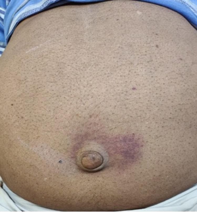 This clinical photograph displays a medium-to-dark-toned adult abdomen, highlighting a distinct pathological sign known as Cullen's sign. The primary finding is a periumbilical ecchymosis, characterized by an irregular, bluish-purple area of subcutaneous hemorrhage surrounding the umbilicus. The discoloration is most prominent on the right side of the umbilical ring, presenting as a mottled, bruised patch. Anatomically, the image covers the umbilical, epigastric, and portions of the lateral abdominal regions. In addition to the ecchymosis, a faint, linear surgical scar is visible in the upper left quadrant, along with scattered benign-appearing nevi. Clinically, Cullen's sign is an important diagnostic indicator of retroperitoneal hemorrhage, often associated with severe acute pancreatitis, ruptured ectopic pregnancy, or aortic aneurysm. This image serves as a teaching tool for medical students and clinicians to recognize superficial manifestations of internal abdominal pathology during a physical examination.
