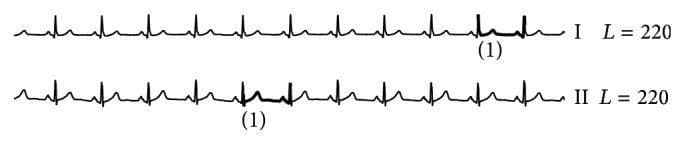 The image displays two continuous electrocardiogram (ECG) waveforms labeled as Lead I and Lead II, recorded from the INCARTDB01 dataset. Each strip exhibits multiple sequential cardiac cycles characterized by normal sinus morphology, including distinct P-waves, QRS complexes, and T-waves. A specific segment in each lead is highlighted with a thickened line and annotated with the numeral '(1)'. In Lead I, the highlighted segment shows a deviation in the ST-segment and T-wave morphology compared to adjacent beats. In Lead II, the highlighted area demonstrates an inverted T-wave. Each waveform is accompanied by the annotation 'L=220', indicating the window length or number of data points analyzed. This visual illustrates a false alarm result in automated ECG anomaly detection, where normal physiological variations or minor artifacts are incorrectly flagged as pathological events by computational algorithms like BitClusterDiscord. The content is used to demonstrate challenges in signal processing and the importance of morphological accuracy in cardiac arrhythmia monitoring.