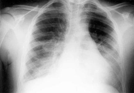 A posterior-anterior (PA) view diagnostic chest X-ray illustrating pulmonary manifestations in a patient with status asthmaticus and concurrent Mycoplasma pneumoniae infection. The radiographic findings are characterized by bilateral, diffuse, and patchy interstitial infiltrates, most prominent in the basilar regions of both lung fields. There is a general decrease in pulmonary transparency at the bases, indicating areas of consolidation or fluid accumulation consistent with atypical pneumonia. The cardiac silhouette appears within normal limits for size and morphology, and the visible mediastinal structures are unremarkable. The skeletal framework, including the ribs and clavicles, shows no acute abnormalities. This image serves as a clinical example of secondary pulmonary infection complicating an acute exacerbation of reactive airway disease, highlighting the characteristic 'walking pneumonia' presentation on plain film radiography.