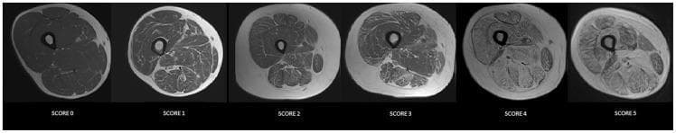 This diagnostic image set consists of six T1-weighted axial MRI scans of the human thigh, demonstrating the Modified Mercuri scale for grading muscular fatty replacement. The series illustrates a progressive increase in signal hyperintensity within the skeletal muscle compartments, corresponding to adipose tissue infiltration. Score 0 shows normal muscle bulk and signal. Score 1 identifies an 'early moth-eaten' appearance with scattered hyperintense punctate areas. Scores 2 and 3 show increasing confluence of fatty signal, involving <30% and 30-60% of the muscle volume, respectively. Score 4 exhibits a 'faded' appearance with dominant fatty signal, and Score 5 represents end-stage disease where muscle is almost entirely replaced by adipose and connective tissue, with only thin fascia and neurovascular bundles remaining visible. This visual scale is essential for the clinical evaluation of neuromuscular disorders and myopathies, providing a standardized method to quantify disease progression and muscular involution.
